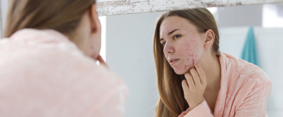 Woman with acne looking in the mirror